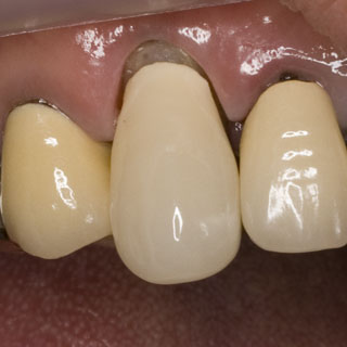 陶材焼付金属冠