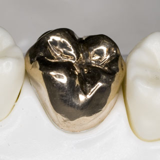 白金加金全部鋳造冠